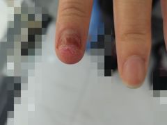 -Andrew指甲专科灰指甲·甲沟炎矫正·3D步态矫形鞋垫定制(浦三路店)