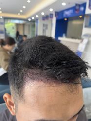 -大麦微针植发全国连锁