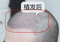-大麦微针植发全国连锁