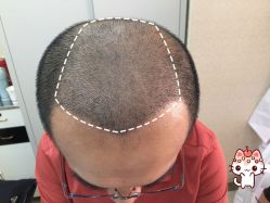 -大麦微针植发丨全国连锁