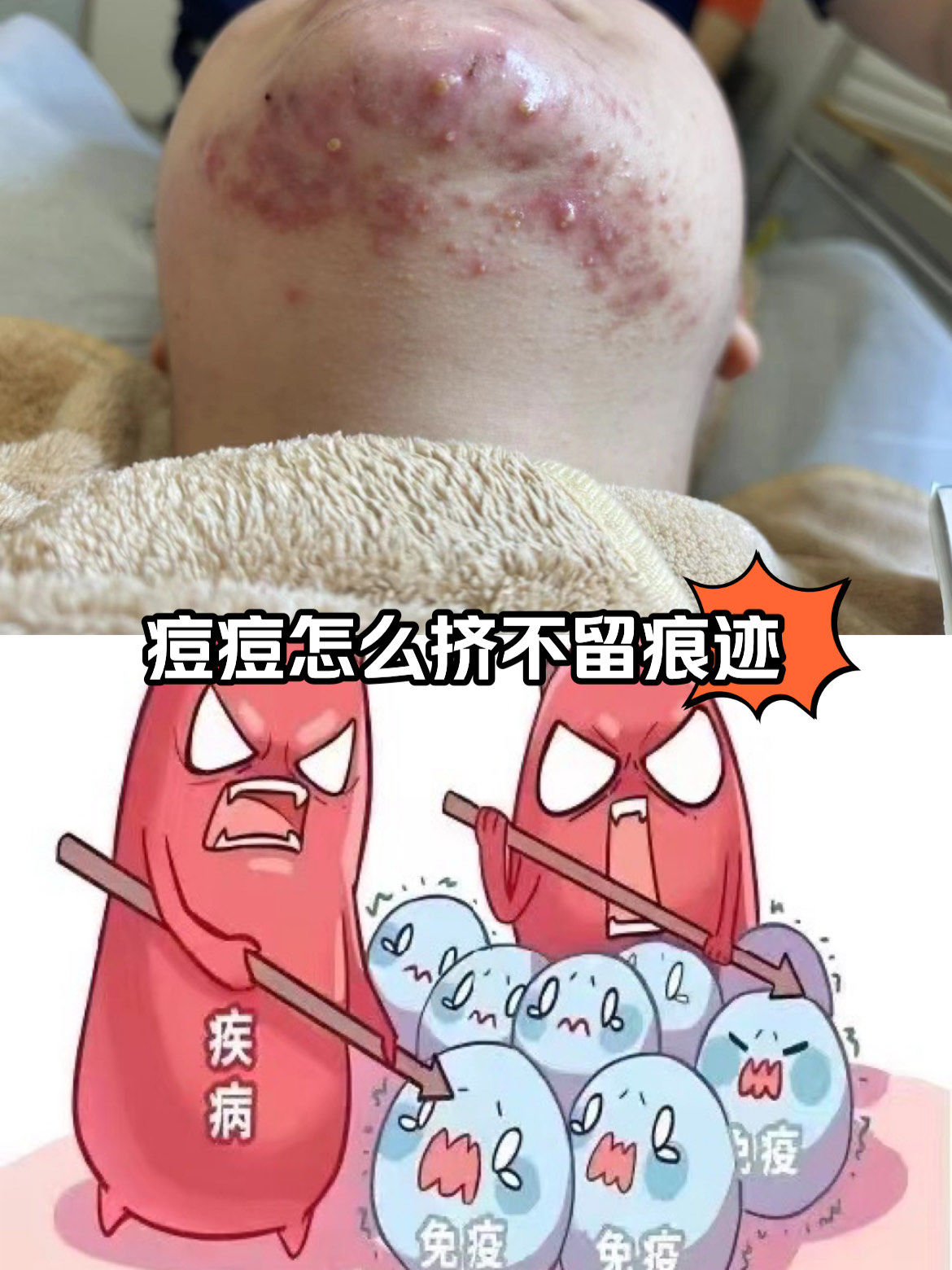 痘痘怎么挤不留痕迹?