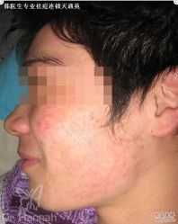 -韩医生专业祛痘连锁机构