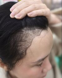 -碧莲盛·不剃发植发