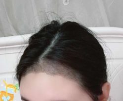 -大麦微针植发丨全国连锁