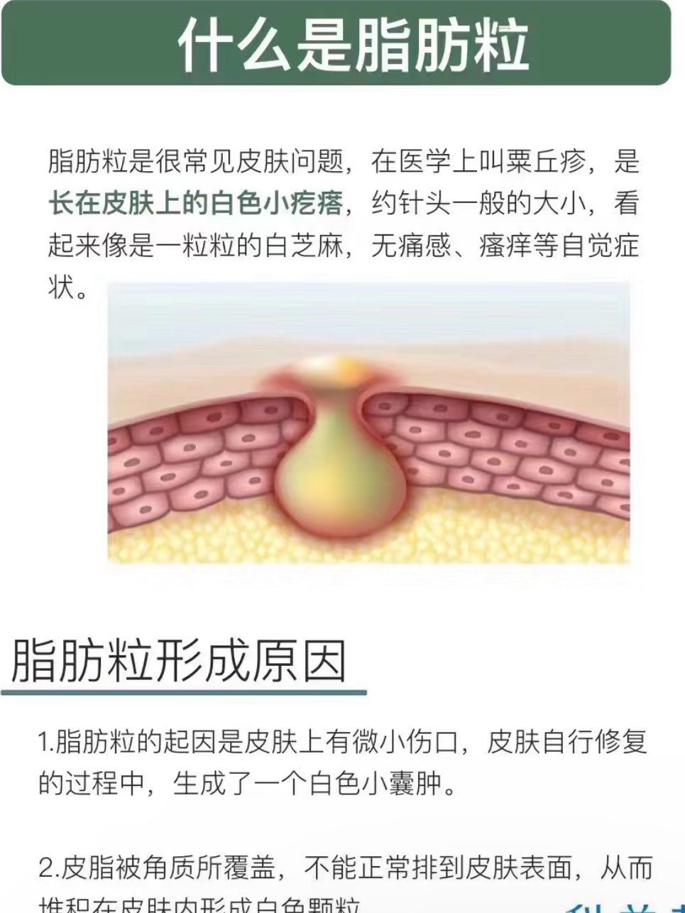 去脂肪粒最有效的方法图片