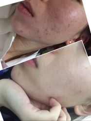 -苗方清颜痘肌研究所