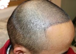 -大麦微针植发丨全国连锁