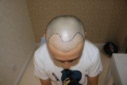 -大麦微针植发丨全国连锁