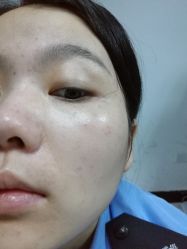 -美丽人生祛斑扁平疣汗管瘤中心