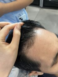 -大麦微针植发全国连锁
