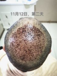 点击看大图 体验后-大麦微针植发丨全国连锁