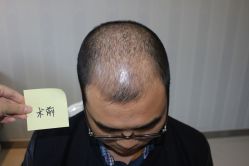 -大麦微针植发丨全国连锁