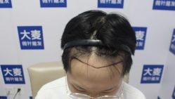 -大麦微针植发丨全国连锁