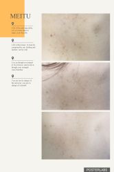 点击看大图 逐步改善-金品苗方专业祛痘中心