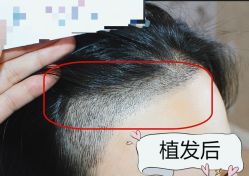 -大麦微针植发全国连锁