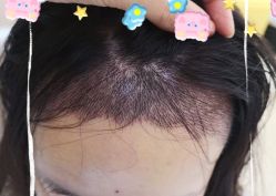 -大麦微针植发全国连锁