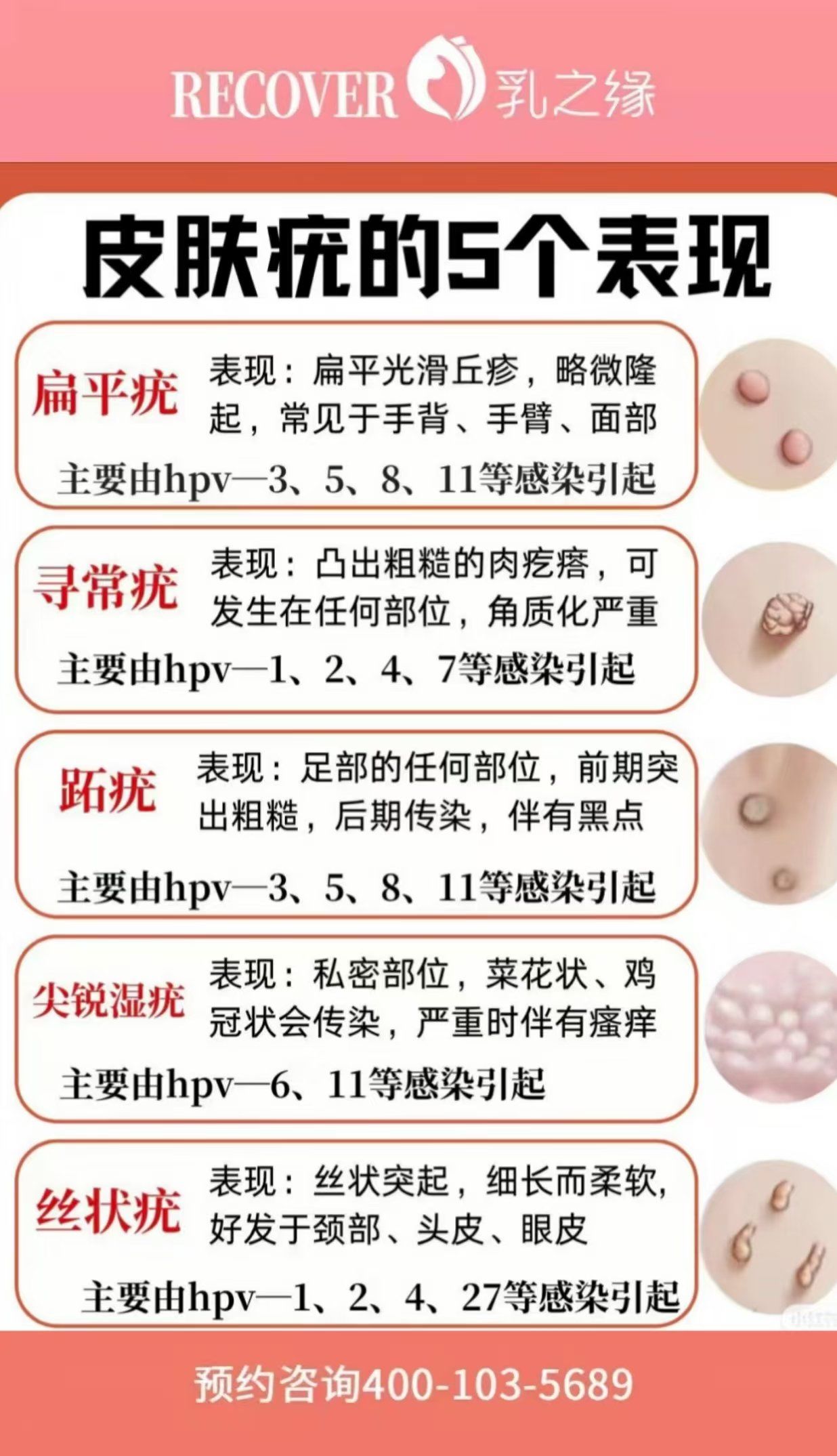 1.扁平疣 表现:扁平光滑丘疹,略微隆起