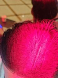 -碧莲盛·不剃发植发