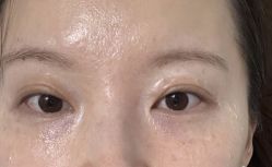 -爱莎扁平疣·汗管瘤·斑痣中心