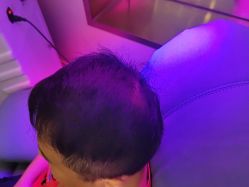 -碧莲盛·不剃发植发