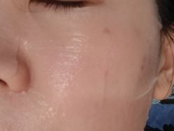 体验后-正璞医疗美容·皮肤修复·微整注射