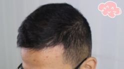 -大麦微针植发丨全国连锁