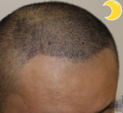 -大麦微针植发丨全国连锁