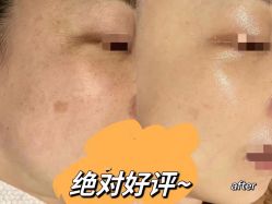 -美丽人生祛斑扁平疣汗管瘤中心