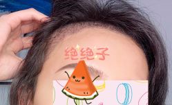 -大麦微针植发全国连锁