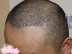 -大麦微针植发丨全国连锁