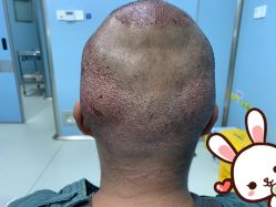 点击看大图 -大麦微针植发丨全国连锁