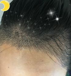 -大麦微针植发丨全国连锁