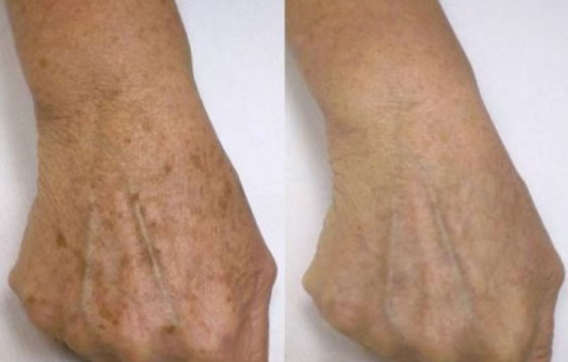 老年斑,也被称为脂溢性角化病