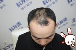 -大麦微针植发丨全国连锁