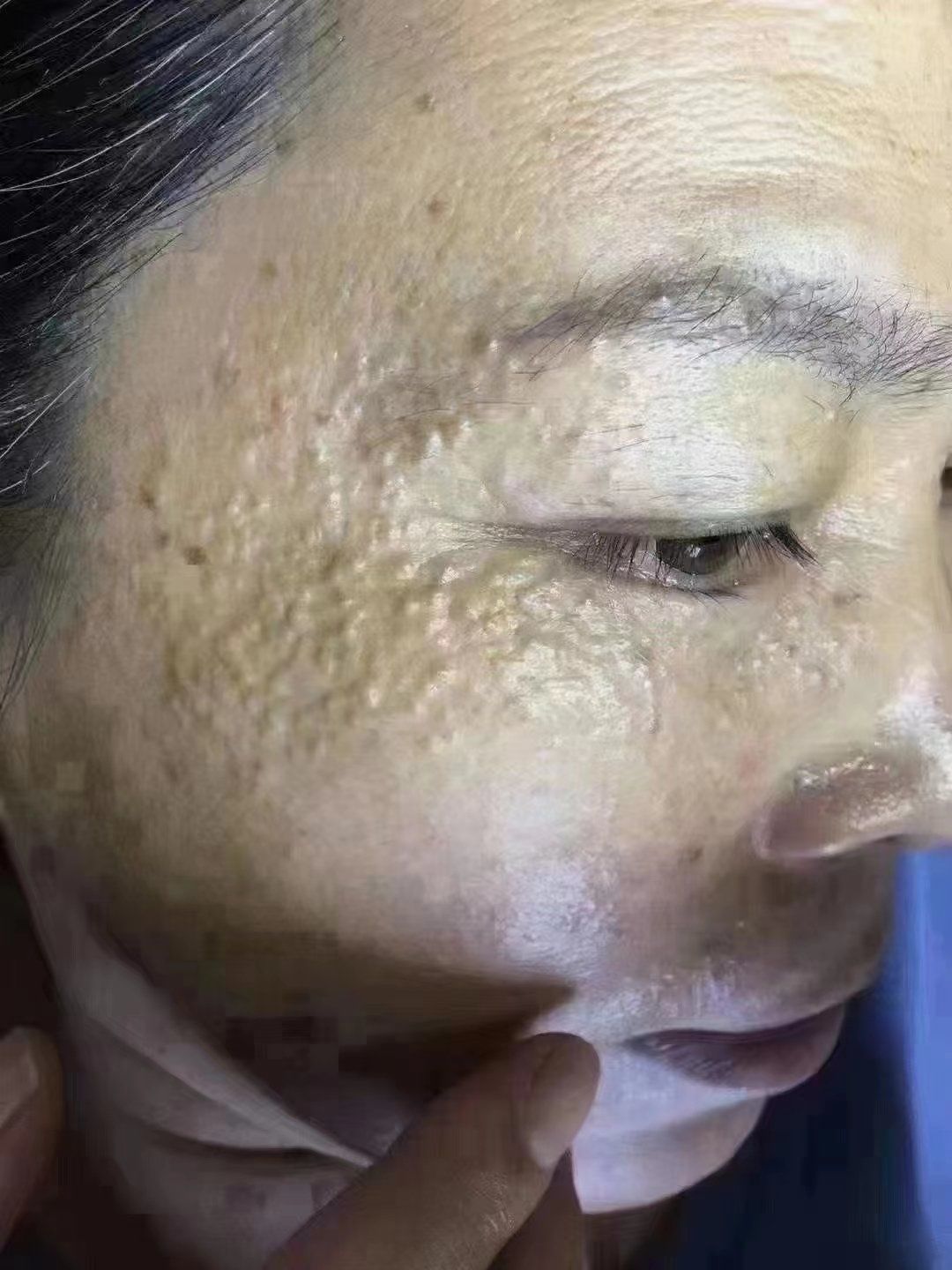 汗管瘤也叫眼部结石