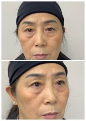 -广州健丽·去眼袋医疗美容机构