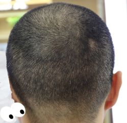 -大麦微针植发丨全国连锁