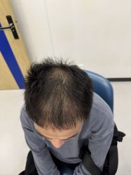 点击看大图 -大麦微针植发全国连锁