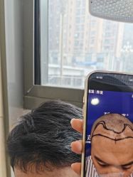 -碧莲盛·不剃发植发