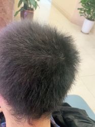 -碧莲盛·不剃发植发