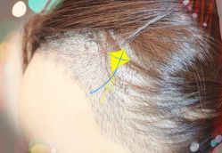 -大麦微针植发全国连锁