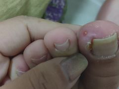 -祖传修脚甲沟炎灰指甲鸡眼