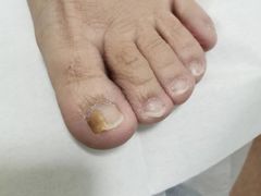 -世龙世家灰指甲鸡眼脚气甲沟炎跖疣护理(通州店)