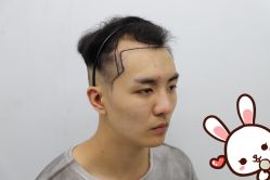 -大麦微针植发丨全国连锁