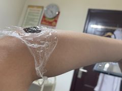 -杭州仁易堂中医康复医院疤痕修复