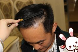 点击看大图 -大麦微针植发丨全国连锁