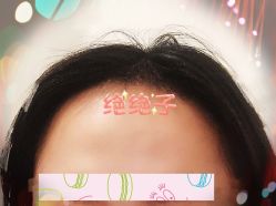 -大麦微针植发全国连锁