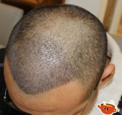 -大麦微针植发丨全国连锁