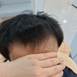 -大麦微针植发丨全国连锁