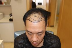 -大麦微针植发丨全国连锁